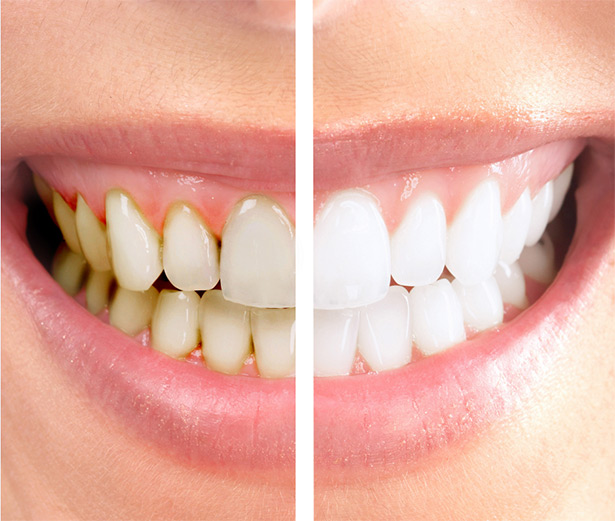 Izbjeljivanje zubi u Ordinaciji dentalne medicine Galeković
