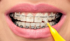 Fiksni aparatić za zube interdnentalna četkica