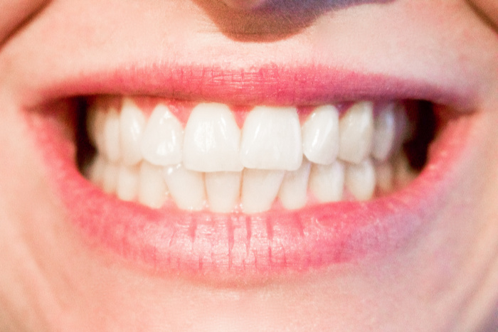 Postupak repozicioniranja usana smanjuje stupanj povlačenja usana i smanjuje izloženost tkiva gingive.