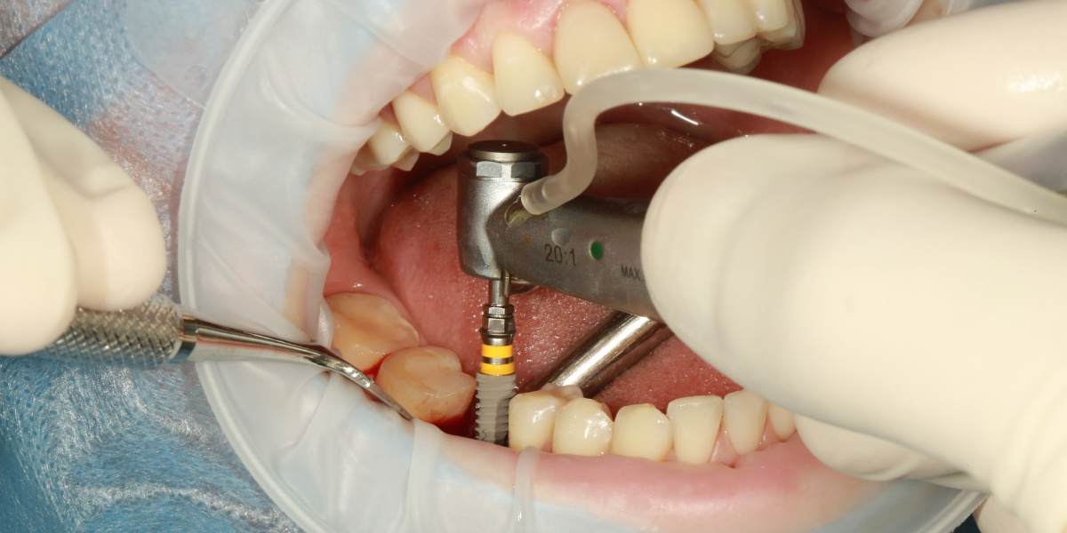 Ugradnja zubnog implantanta je najbolje rješenje ako ste izgubili jedan zub.