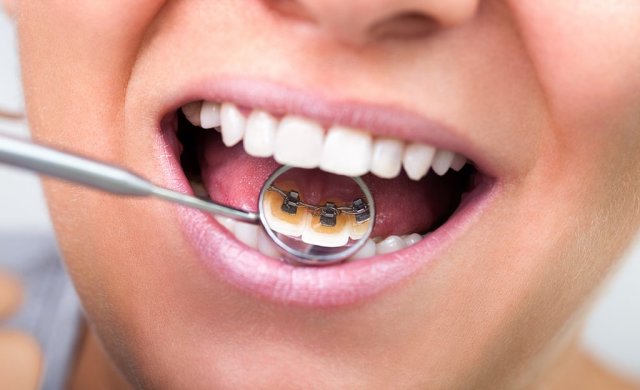Lingvalni aparatić za zube