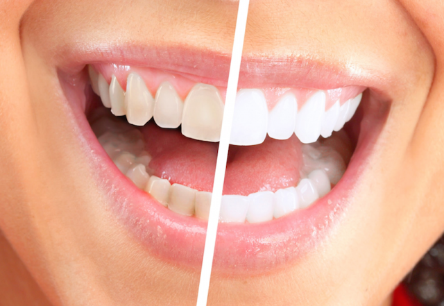 Zoom izbjeljivanje zubi u Ordinaciji dentalne medicine Galeković
