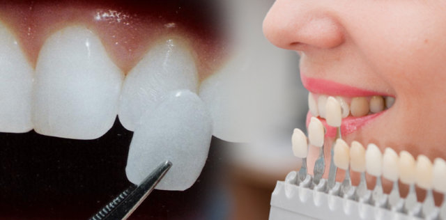 Ljuskice za zube su površinske navlake