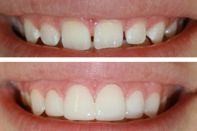 Ljuskice za zube smanjuju razmak između zubi