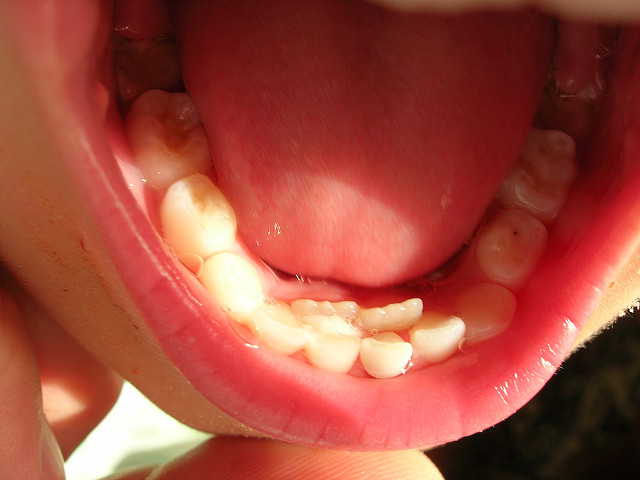 Mliječni zubi nisu ispali nakon rasta trajnih