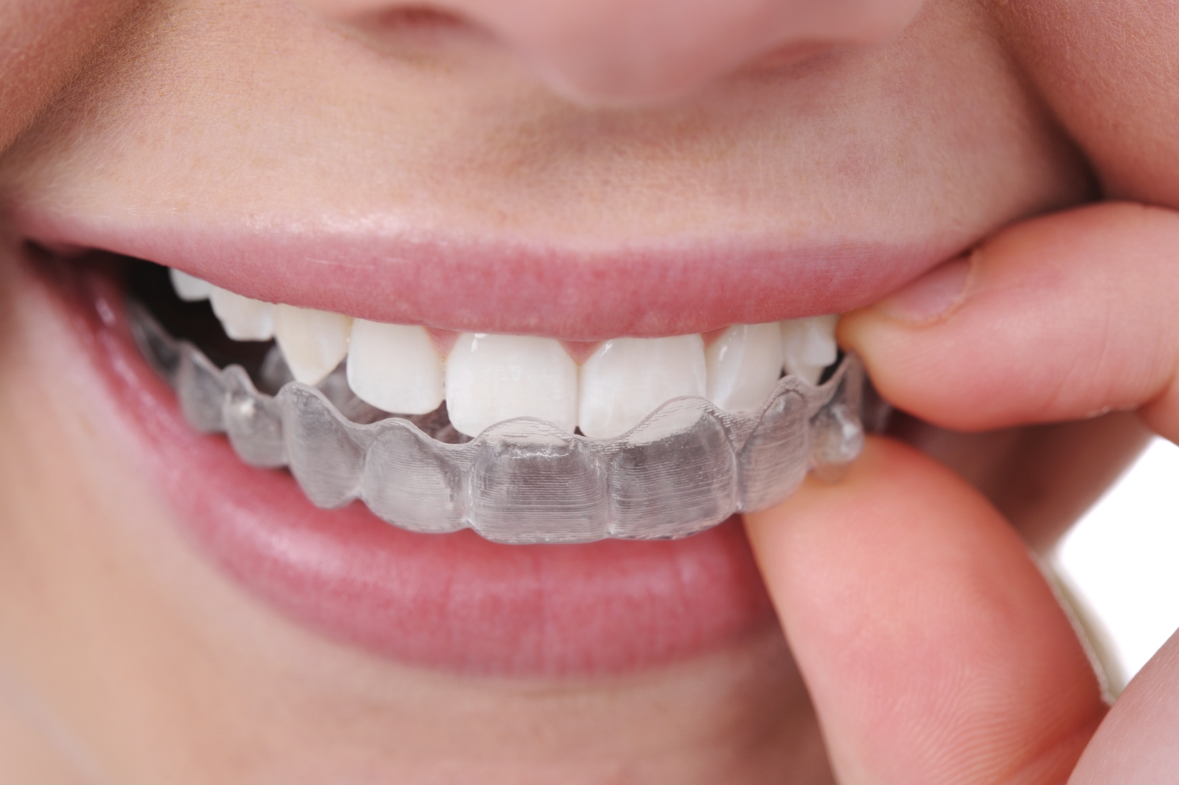 Retencija zubi jednako je važna kao i nošenje fiksnog aparatića