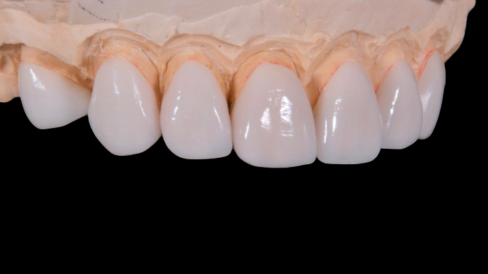Ljuskice za zube izvrsna su opcija za zube koji su promijenili boju, a izbjeljivanje neće pomoći.