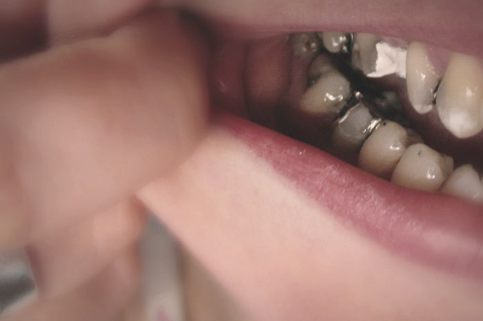 Zubi se kvare zbog loše ishrane.