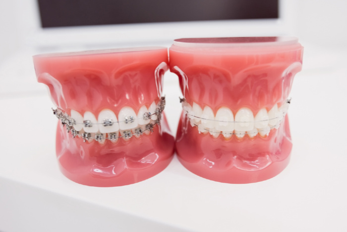 Fiksna ortodontska terapija najučinkovitiji je način ispravljanja ortodontskih anomalija.