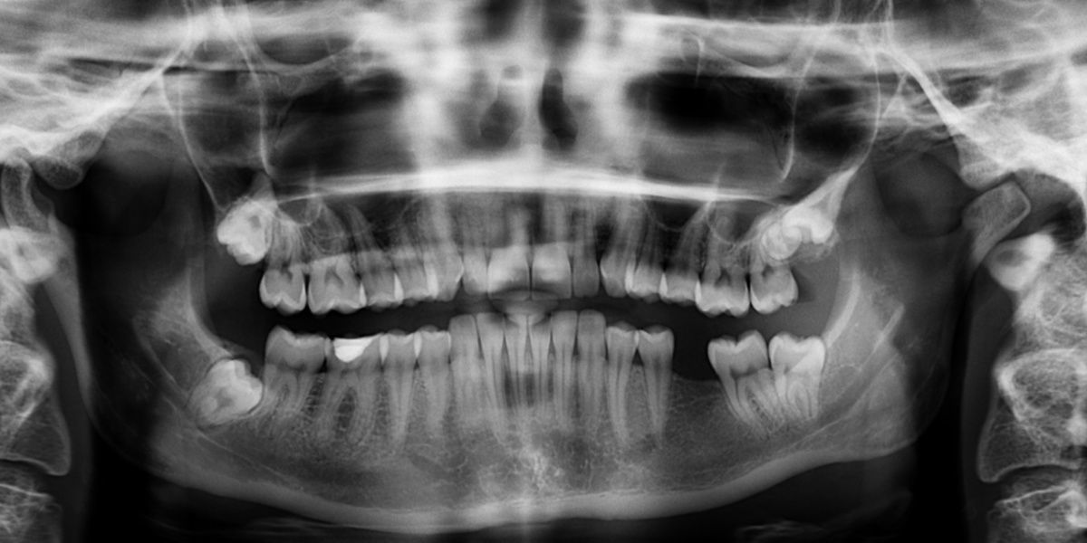 Gubitak zuba može narušiti stabilnost zubi i prouzročiti smetnje u žvakanju.