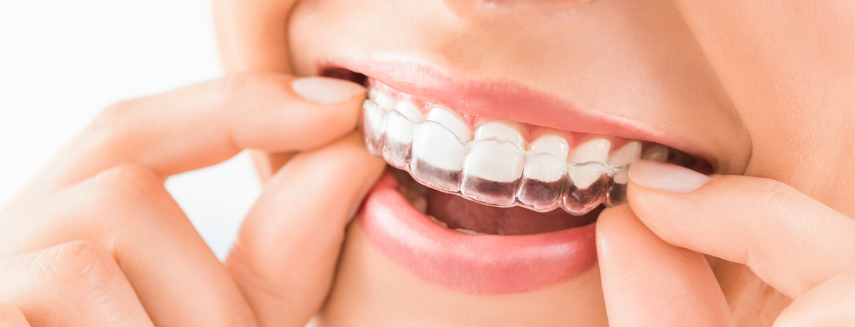 Prozirne folije Invisalign aparatića za zube neprimjetne su i ne smetaju vašim svakodnevnim aktivnostima