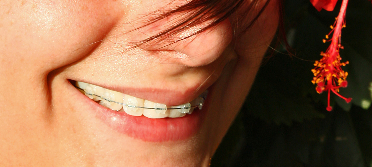 Retencija je postupak koji se provodi nakon skidanja aparatića za zube