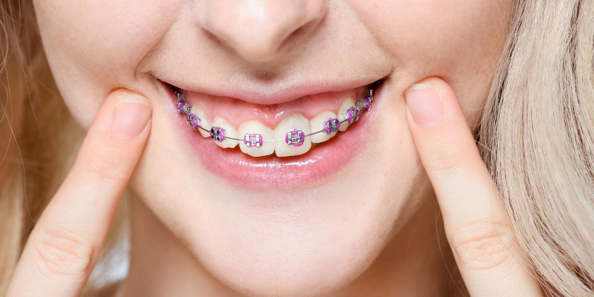 Ortodontska terapija je i postavljanje fiksnog aparatića za zube