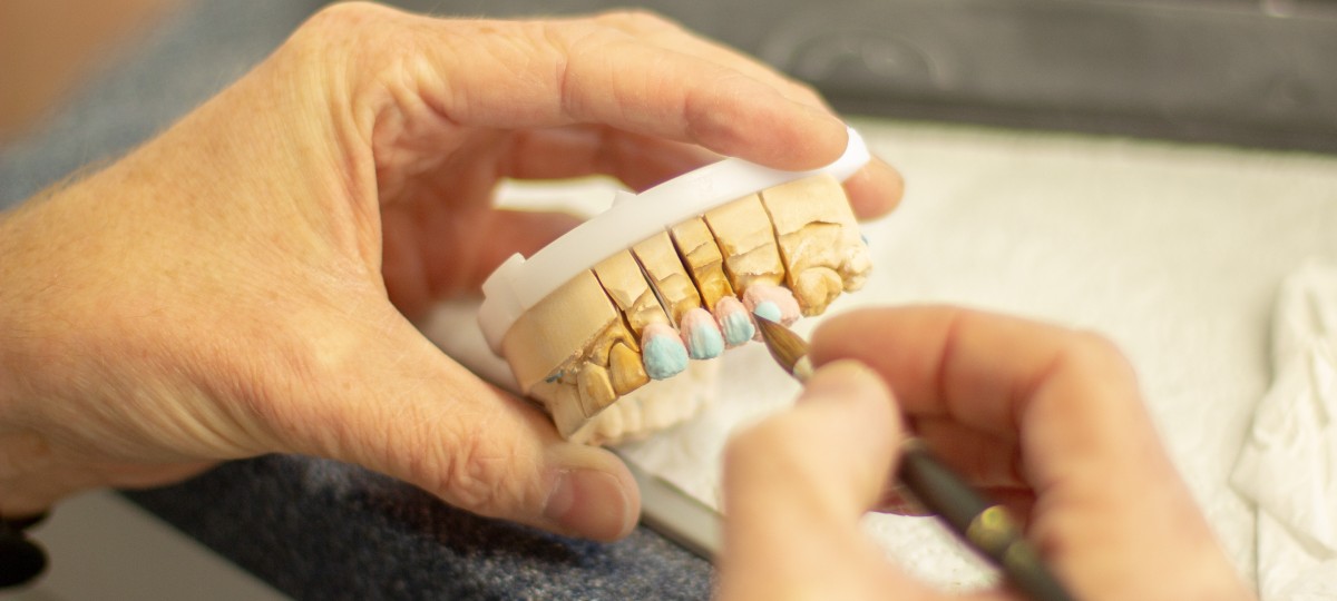 Keramičke ljuskice izrađuju se u dentalnom laboratoriju
