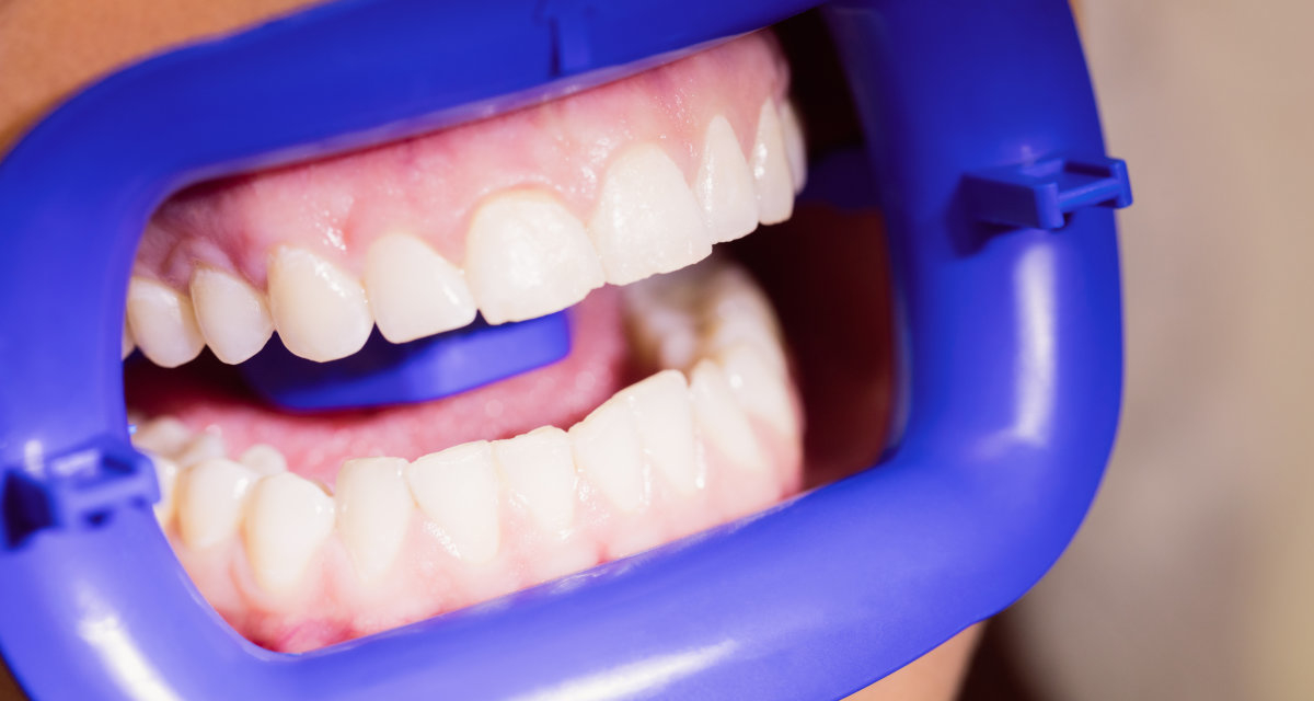 ZOOM lambası ile profesyonel beyazlatma sırasında dudaklar ve diş etleri korunur